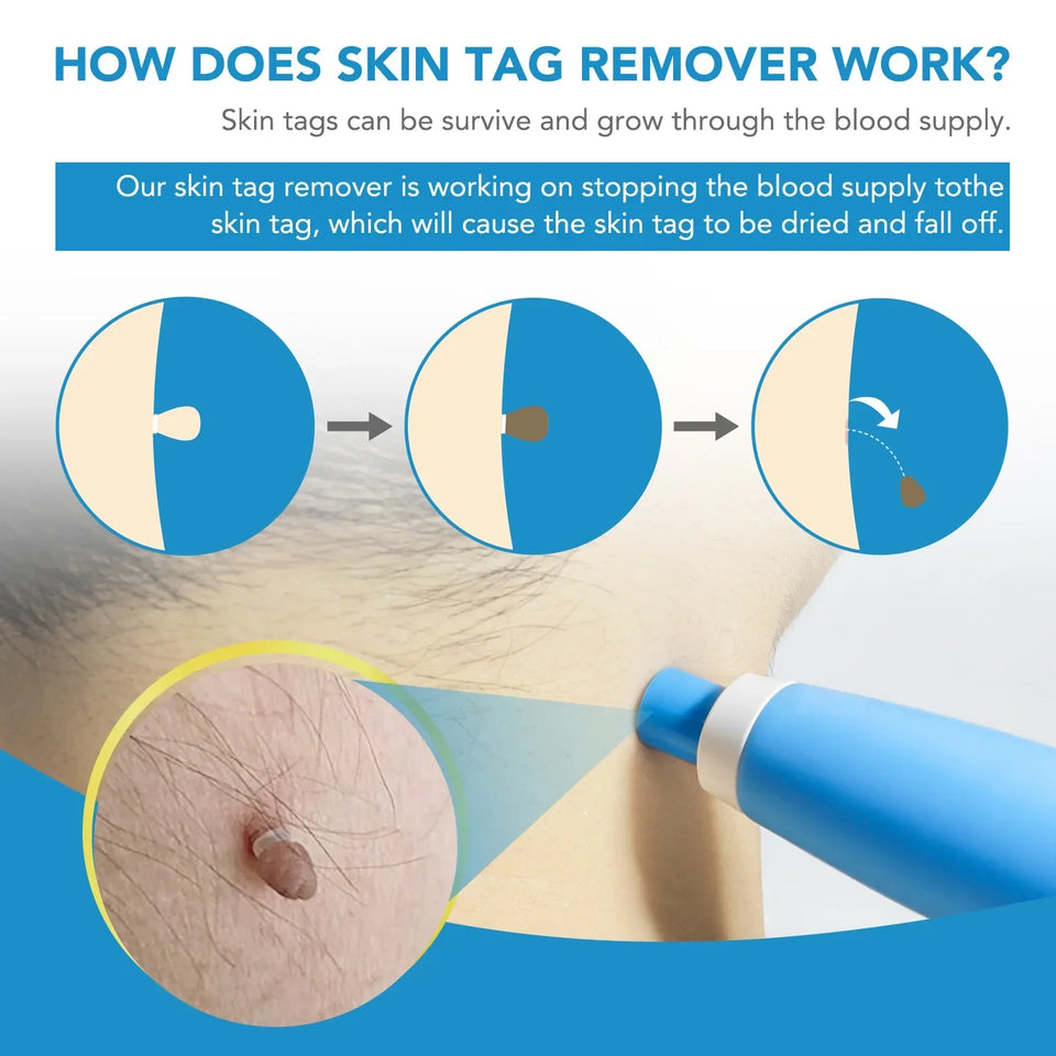 2 In 1 Auto Micro Skin Tag Remover Device Portable Skin Tag Removal Kit Adult Mole Stain Wart Corn Remover Face Care Beauty Tool